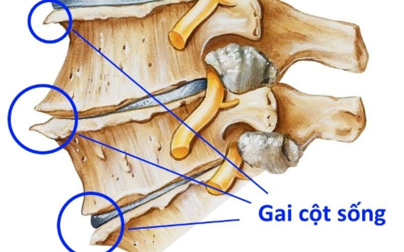 Tổng Quan Về Thoái Hóa Khớp Cột Sống Thắt Lưng