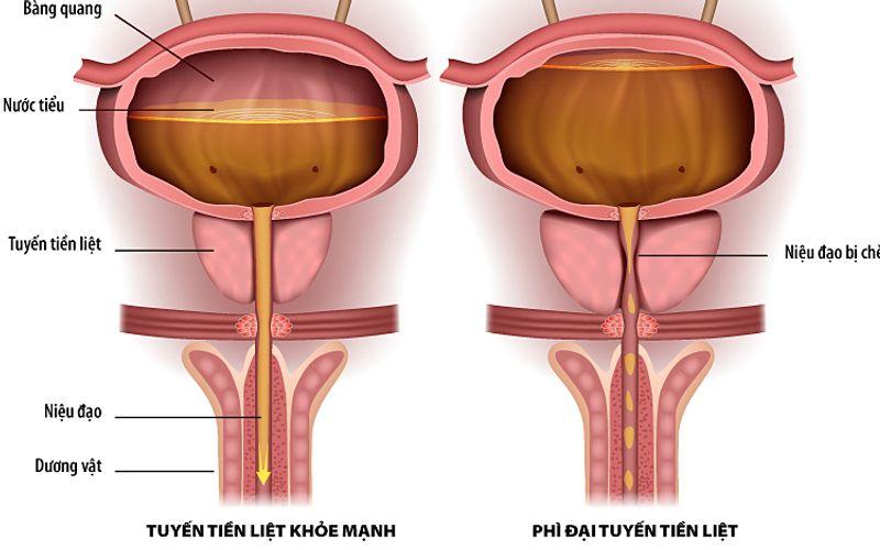 Phì Đại Lành Tính Tuyến Tiền Liệt: Triệu Chứng, Nguyên Nhân, Điều Trị và Biến Chứng